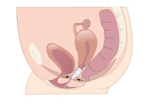 Pesas vaginales 2